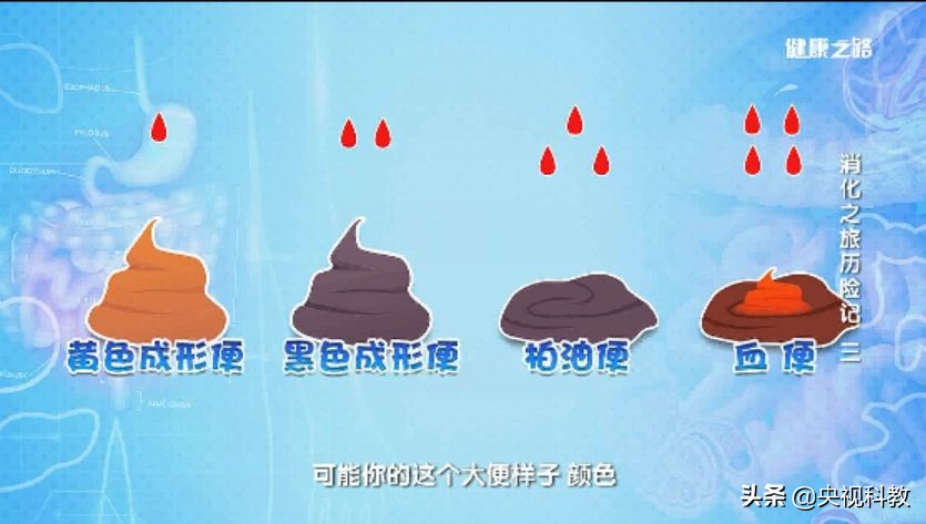 胃溃疡幽门螺杆菌中药治疗,胃溃疡加幽门螺杆菌的详细用药