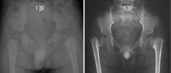 小孩走路不稳摇摇晃晃,孩子走路摇晃怎么回事