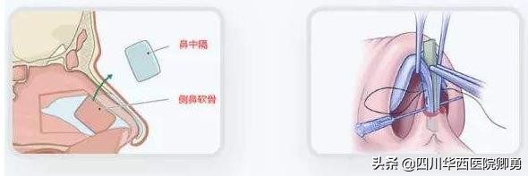 鼻中隔耳软骨隆鼻有哪些优缺点,鼻中隔隆鼻是取鼻中隔软骨吗