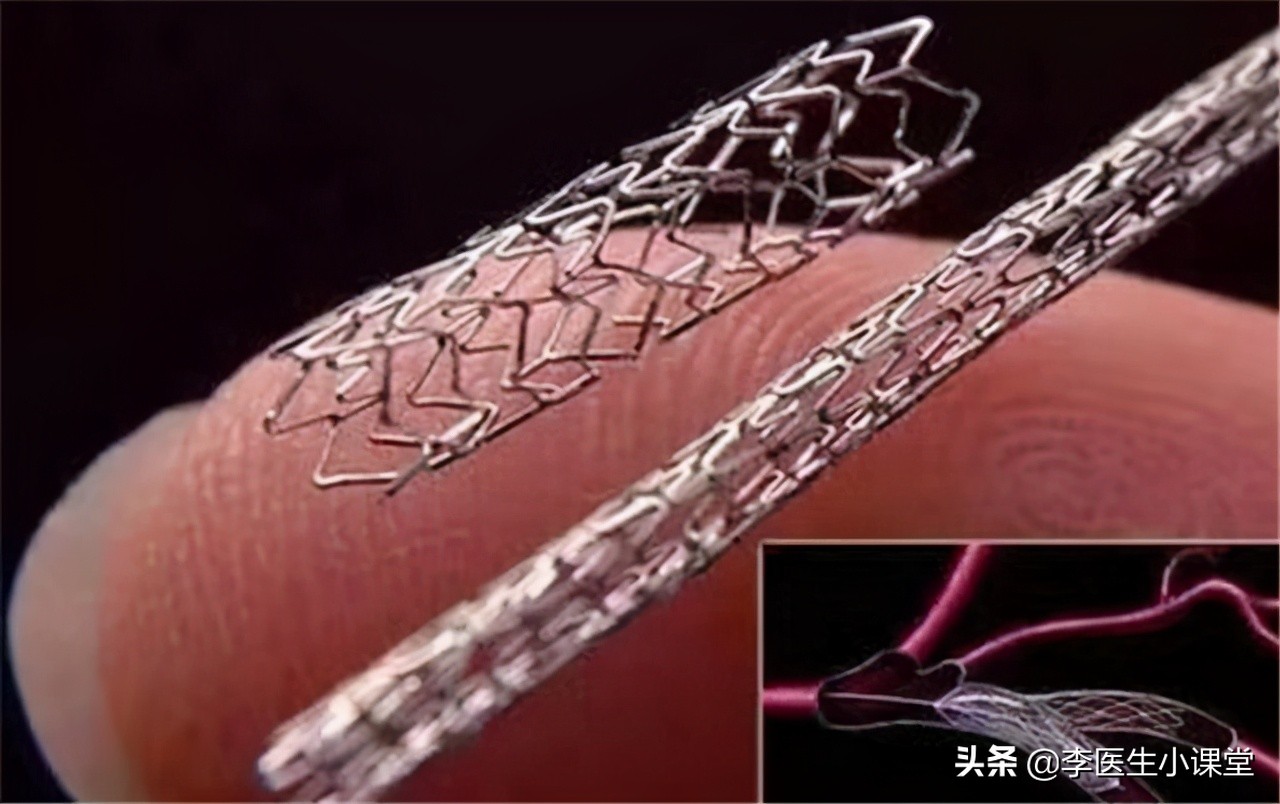 48岁心肌梗死不支架可以吗,35岁得心梗没放支架恢复很好