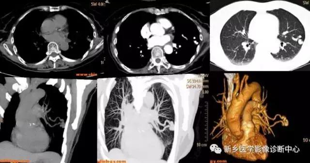 肺部有球形病灶怎么治疗,肺内多发结节诊断早期肺癌怎么办