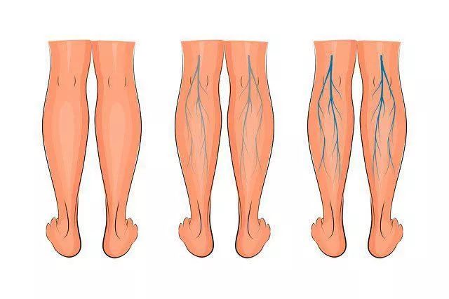 束缚带产后一个月用还有效果吗,束缚带顺产需要用吗