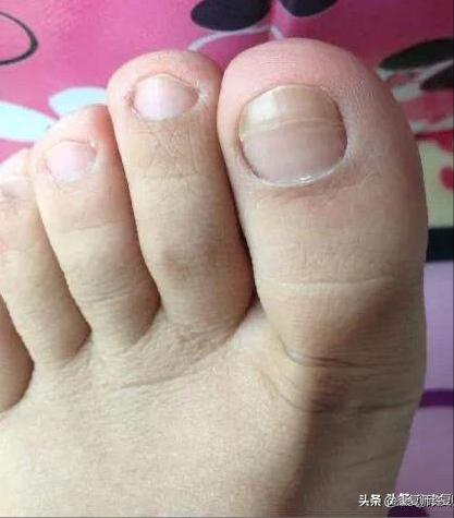 产后腹直肌分离恢复瘦肚子训练,产后腹直肌分离恢复的最佳方法