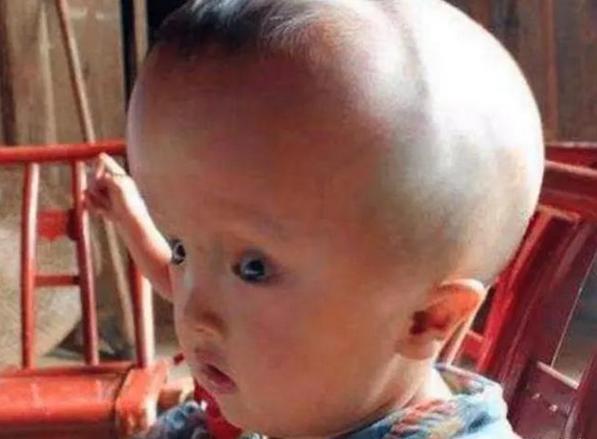 大头娃娃面霜事件官方回应,激素面霜大头娃娃现在怎样了