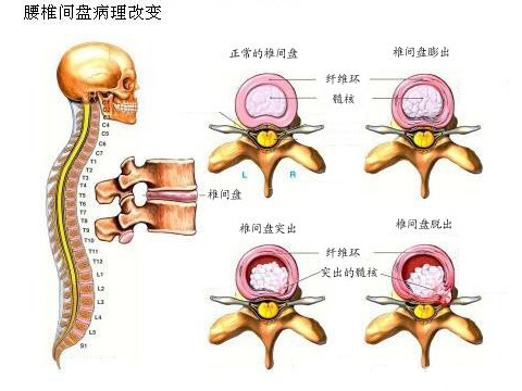 腰椎突出和膨出脱出图片,腰椎间盘突出脱出膨出的区别