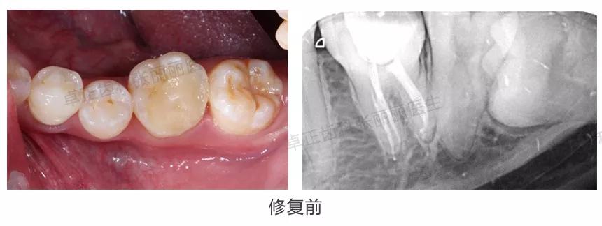 牙齿楔状缺损修复视频,牙齿缺损了可以选择哪些修复方式