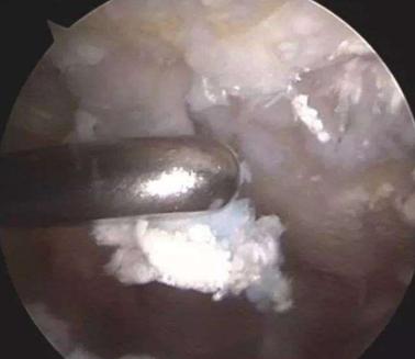 为什么医生不建议痛风石手术,医生为什么不建议痛风石手术