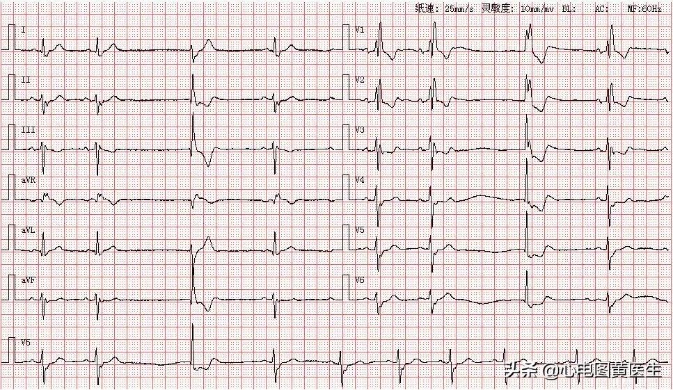 窦房结内游走性心律是什么意思,窦房结内游走性心律不齐
