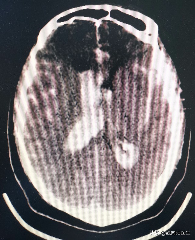 脑出血后积水能好吗,脑出血止住了脑水肿严重吗