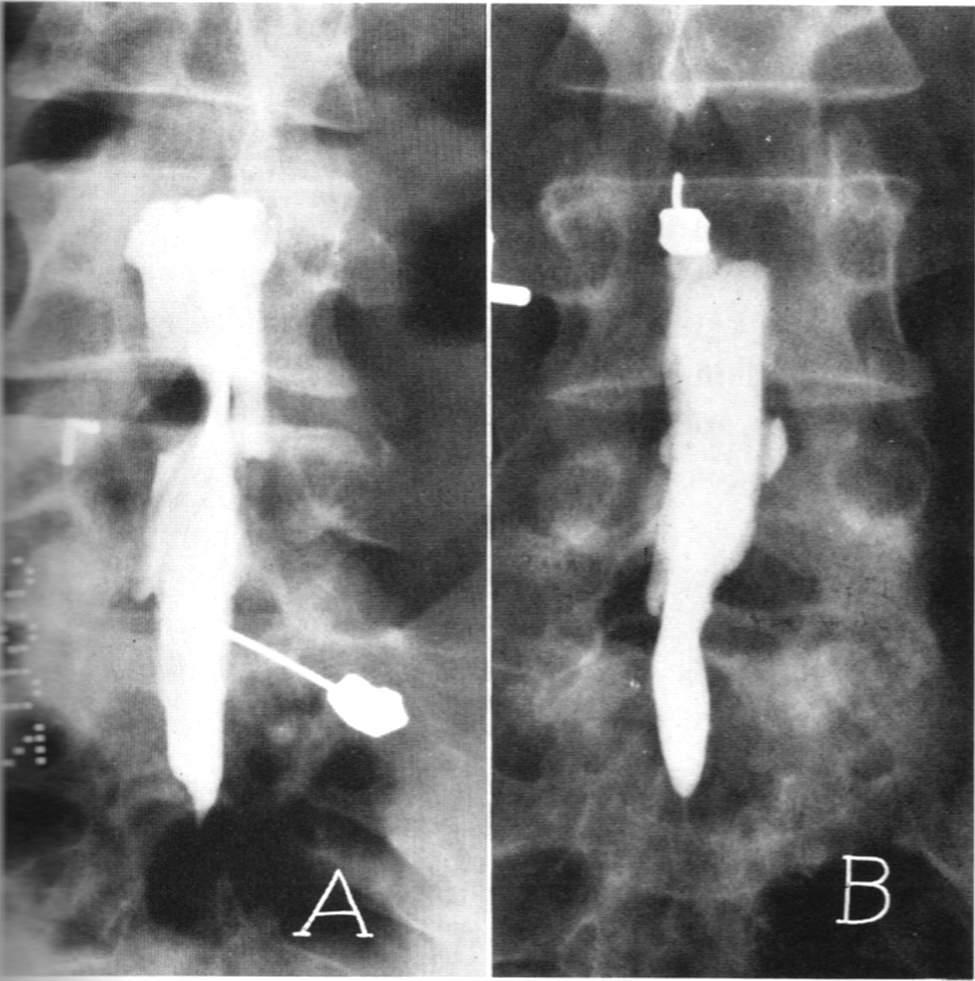 腰椎滑脱和腰椎间盘突出哪个严重,想知道腰椎间盘突出是怎样引起的