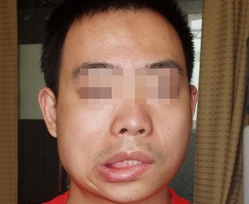 面神经炎是什么原因导致的,面神经炎治疗首选什么药