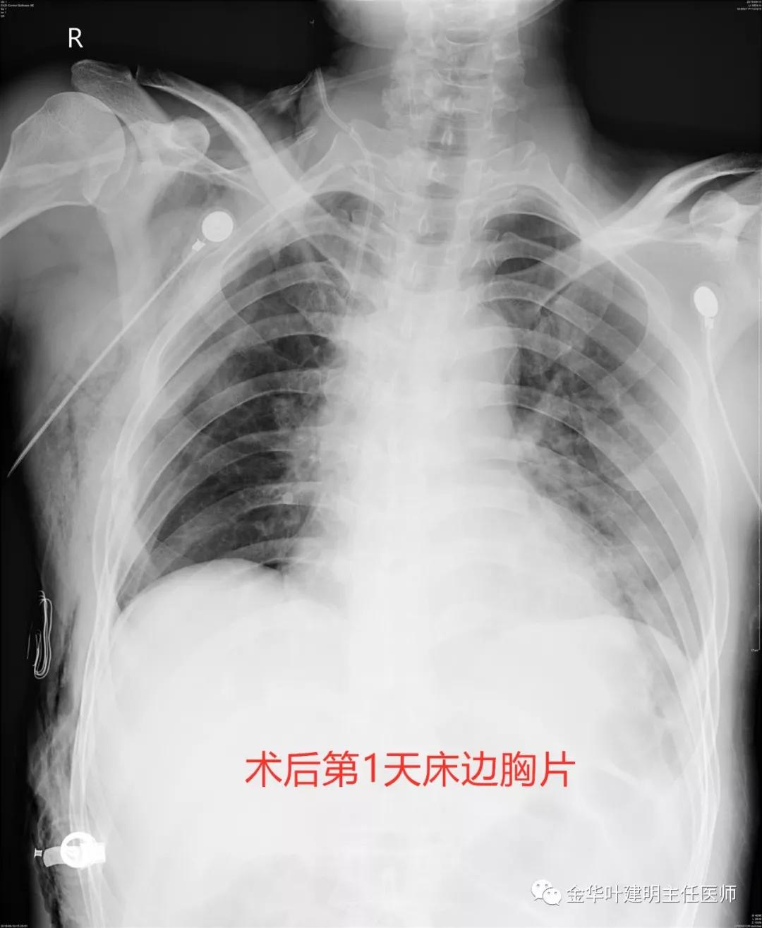 省级医院也漏诊?还好没耽误病情!我们予以行右中下叶袖式切除术