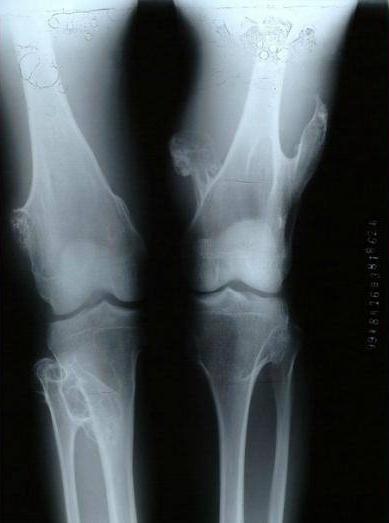 骨软骨瘤癌会遗传吗,骨软骨瘤怎么避免遗传给孩子