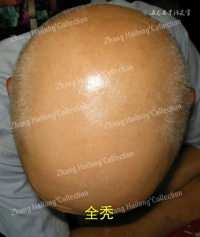 托法替尼治疗斑秃,斑蝥治疗斑秃配方