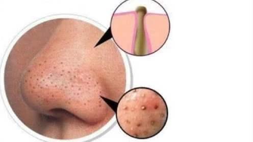 分享去黑头的妙招收藏下来试试吧,教你去除黑头的六个小妙招