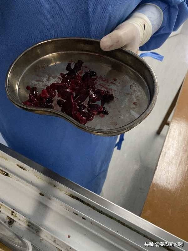 芜湖：网络主播为求美选择隆胸手术后却流血不止…