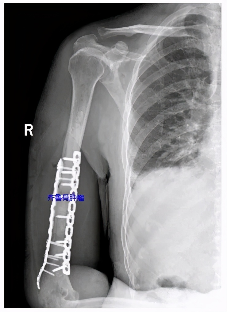 山东齐鲁医院青岛院区射频消融术,齐鲁医院等离子消融术