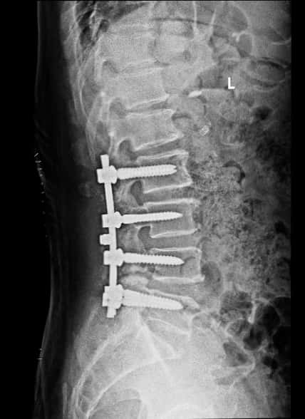 腰椎管狭窄症手术好么,腰椎管狭窄手术和保守治疗哪个好