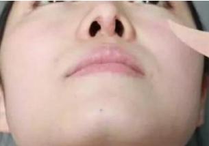 鼻子整形后鼻梁骨增生,鼻子整形增生会疼吗