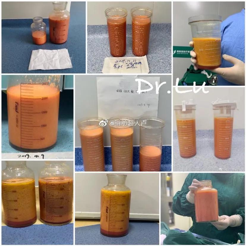 吸脂后腰部有积液抽一次,腰部吸脂一个月还有积液