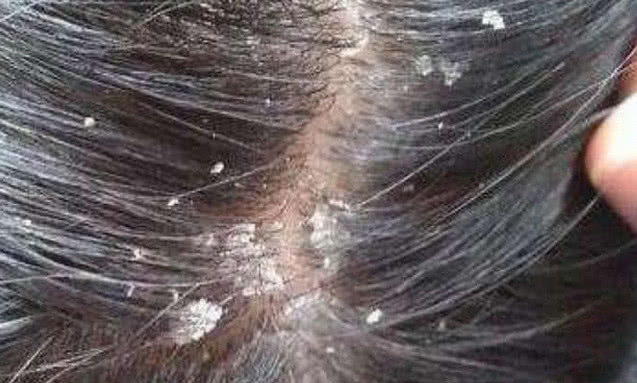 头皮上银屑病头屑洗不干净怎么办,头屑满天飞怎么治疗