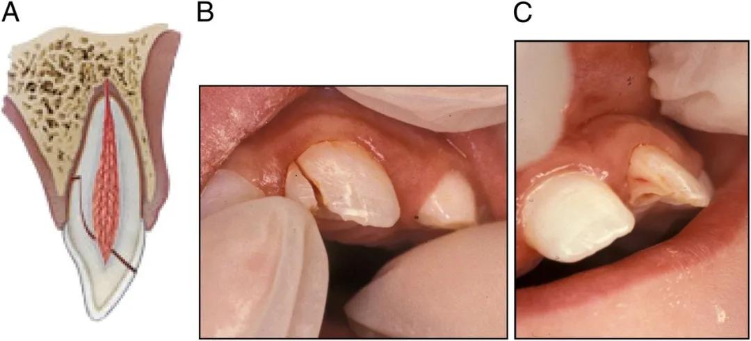 宝宝磕到牙会伤到神经吗,宝宝磕掉乳牙还能再长吗