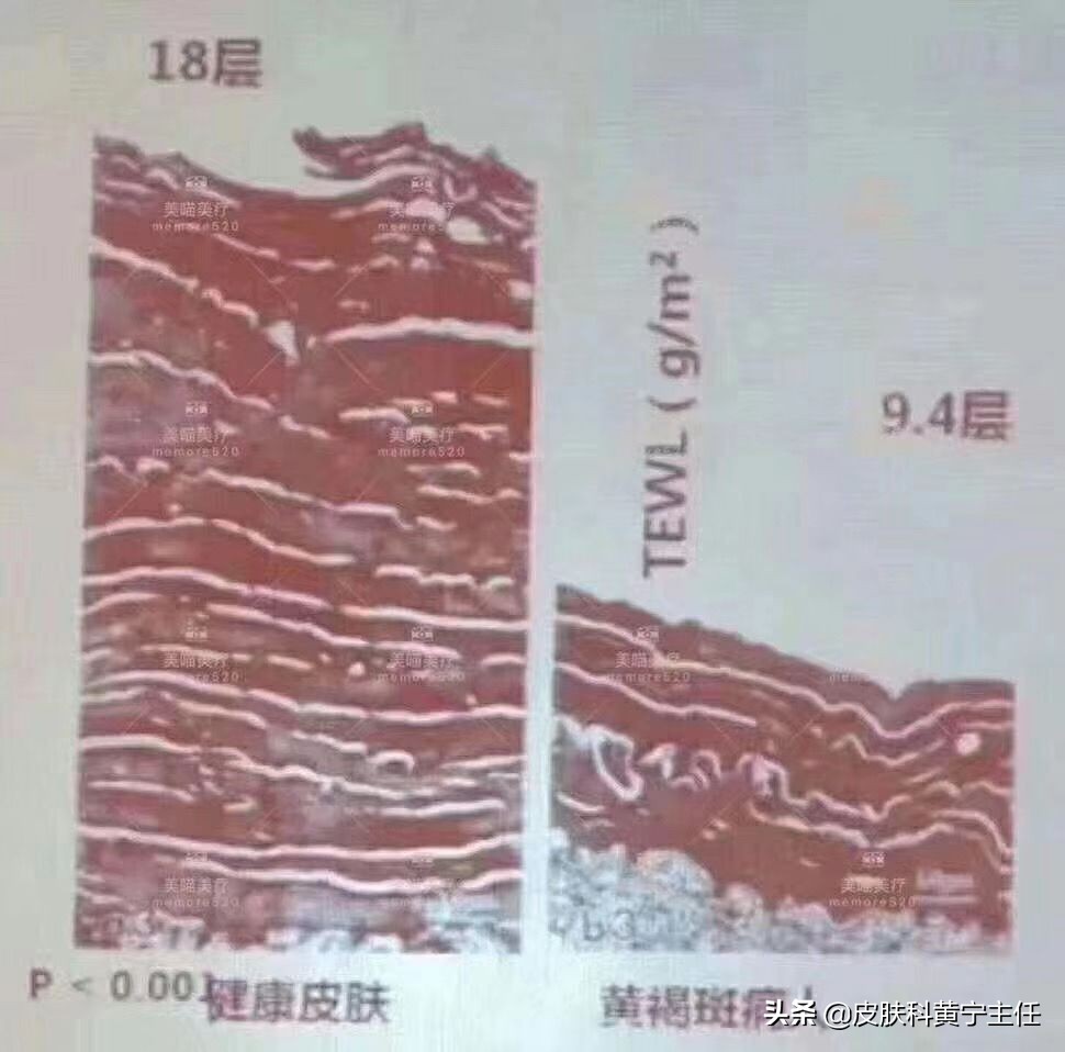 难治的*褐斑黄**，我该拿你怎么办？