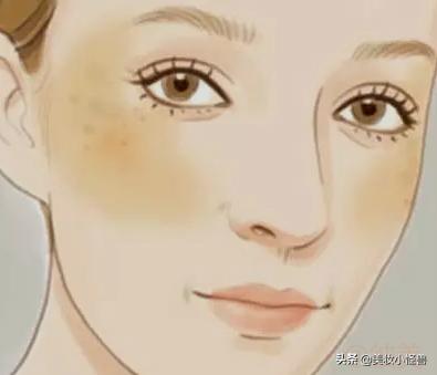 小产后脸上长斑是什么原因,怀孕后脸上长的斑产后怎样去除啊