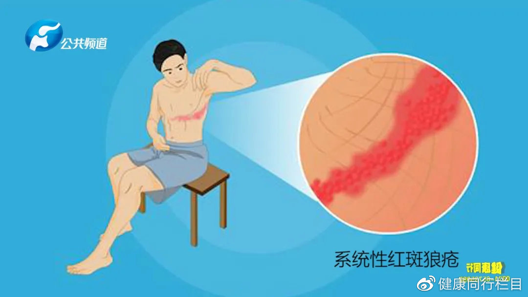 别让风湿恋上你——皮疹？贫血？肾病？可能是系统性红斑狼疮惹的祸！