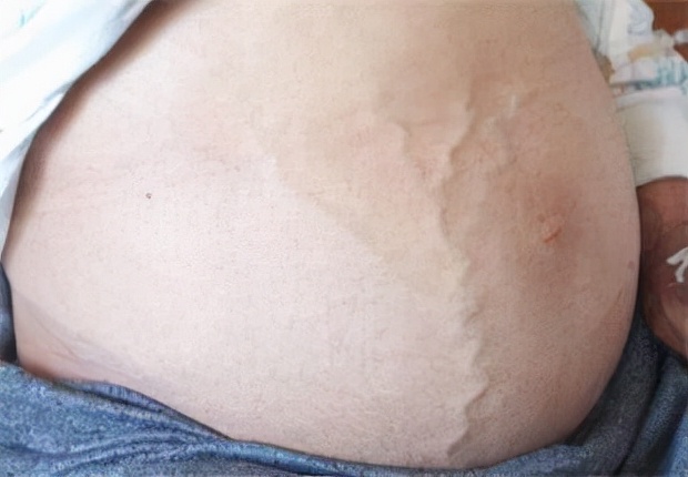 可以不治疗吗？天天吃药太难了