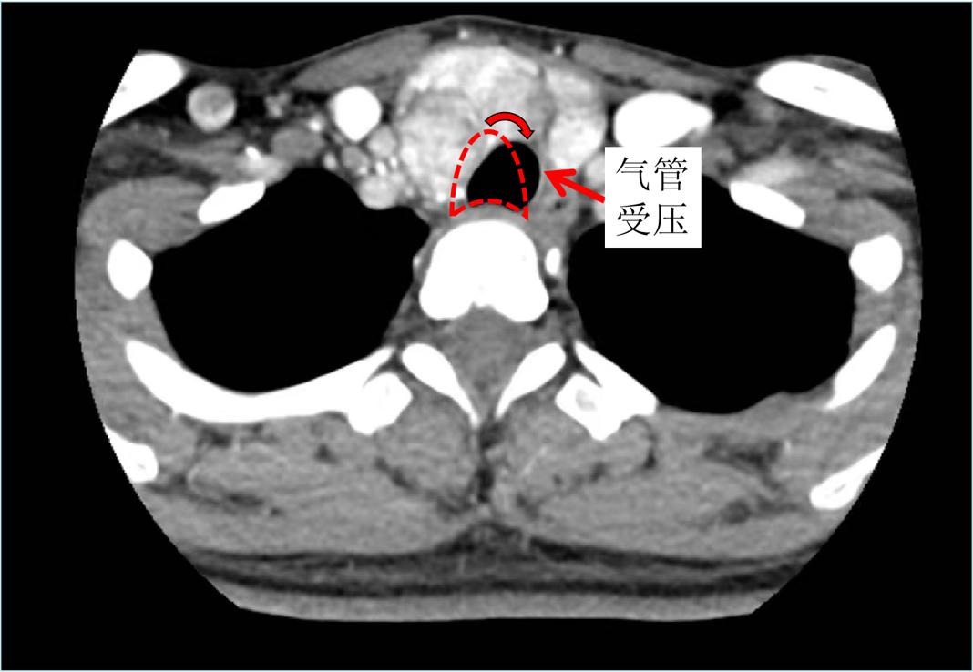 甲状腺结节微创消融手术,甲状腺结节微创消融医保