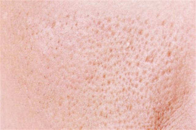 男生毛孔粗大毛孔粗糙怎么办,毛孔粗大怎么办教你一招收缩毛孔