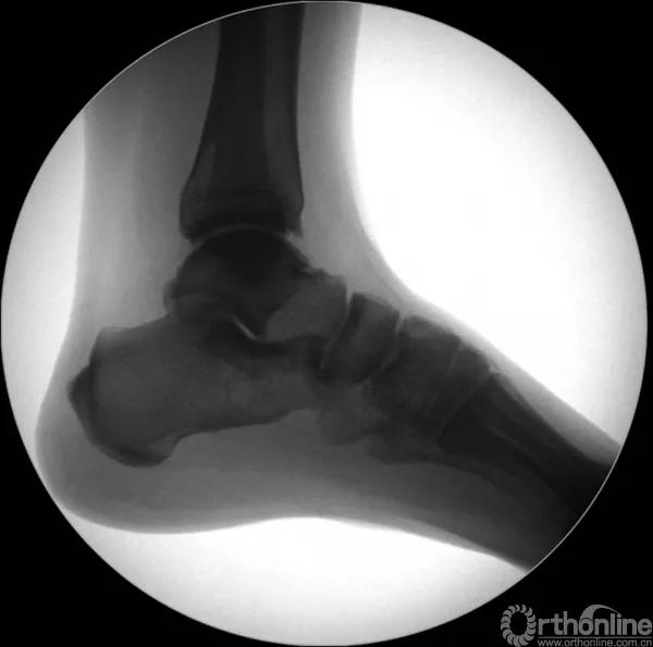 骨折闭合复位髓内钉内固定术,骨折闭合复位