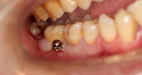 为什么有的人戴牙套要拔牙,为什么有的人戴牙套需要打钢钉