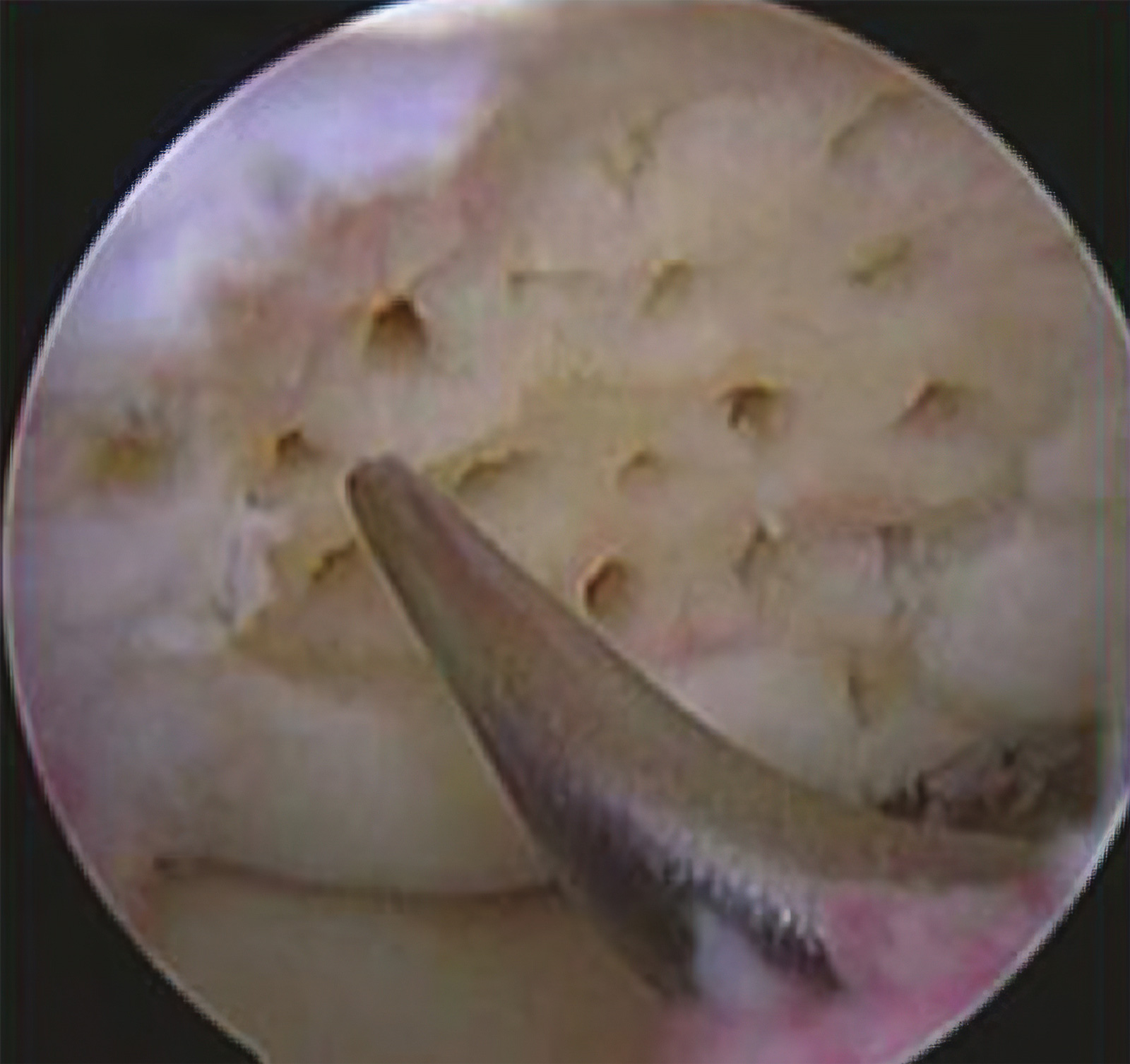 膝关节骨关节炎怎样手术能治好,膝关节镜能治好关节炎吗