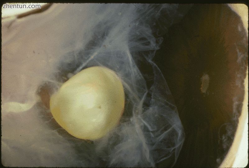 马凡综合征面容,马凡综合征最新标准