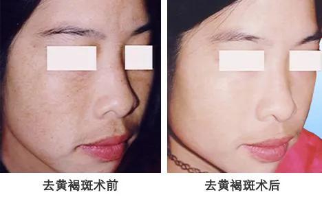 *褐斑黄**、雀斑、黑斑的诊治经验及用方用药一