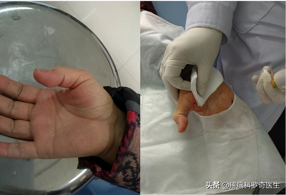 一岁半腱鞘炎最简单自愈方法,腱鞘炎小妙招一招摆脱困扰