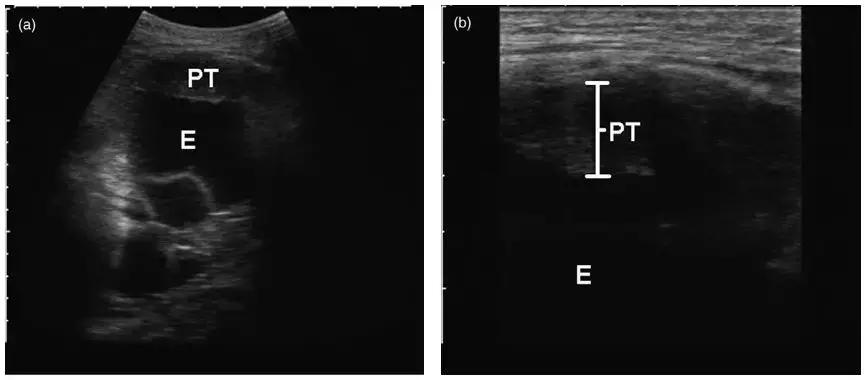 ct引导下穿刺活检诊断的分析,超声引导下穿刺活检什么样子的呢