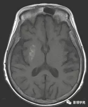 头部t1wi信号不均匀增高,脑t1wi和t2wi稍低信号