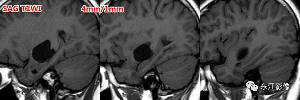 头颅mri扫描影像哪里找,头颅影像mra详细解说