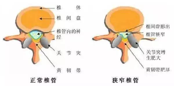 椎间盘突出和椎管狭窄症状的区别,腰椎管狭窄症的症状