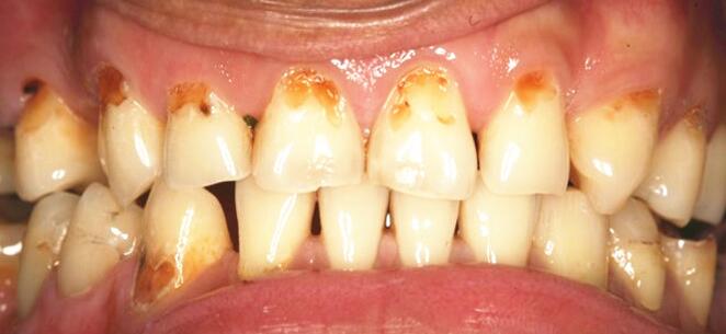 洗牙对牙齿有伤害吗能美白牙齿吗,洗牙美白的最快方法