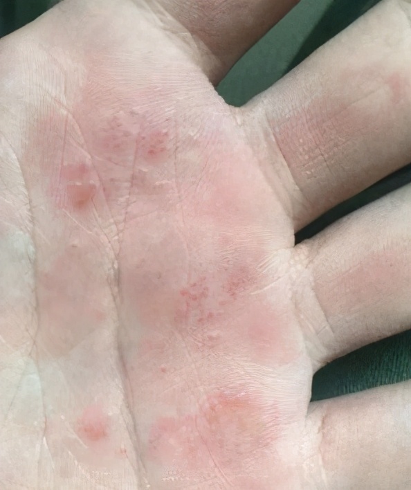 手上起了很多透明小水泡奇痒无比,手上起透明的小疱疹是怎么回事