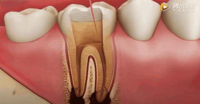 根管治疗可怕,根管治疗很恐怖吗