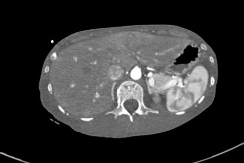 消化道出血高钾血症治疗,诊断高碳酸血症的金标准是什么