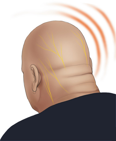 后脑勺一下一下的痛和颈椎有关系吗？枕神经痛的原因、特点和治疗