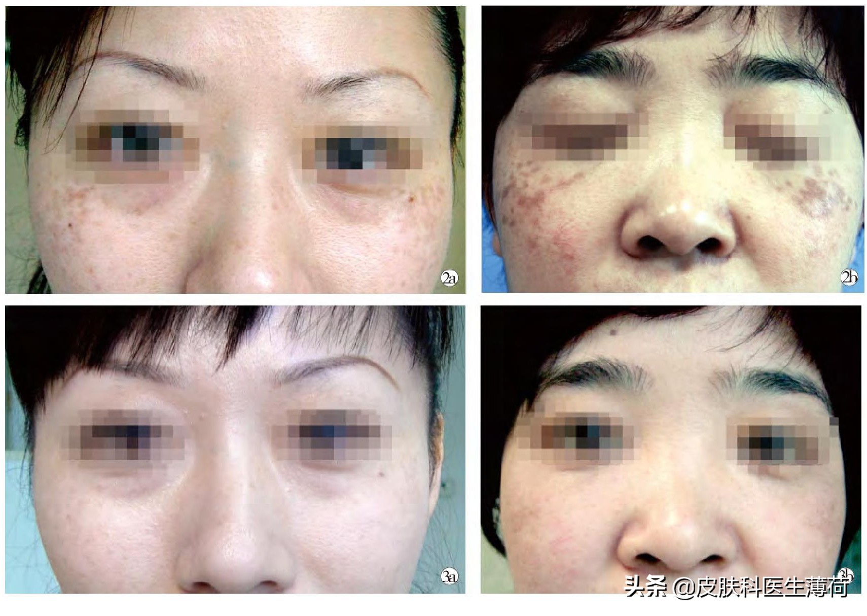 激光祛斑仪雀斑,祛斑祛红色痘印激光