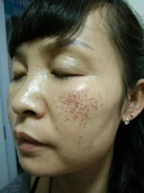 为什么脸上会有细小的血丝出现,为啥有的人脸部有红血丝呢