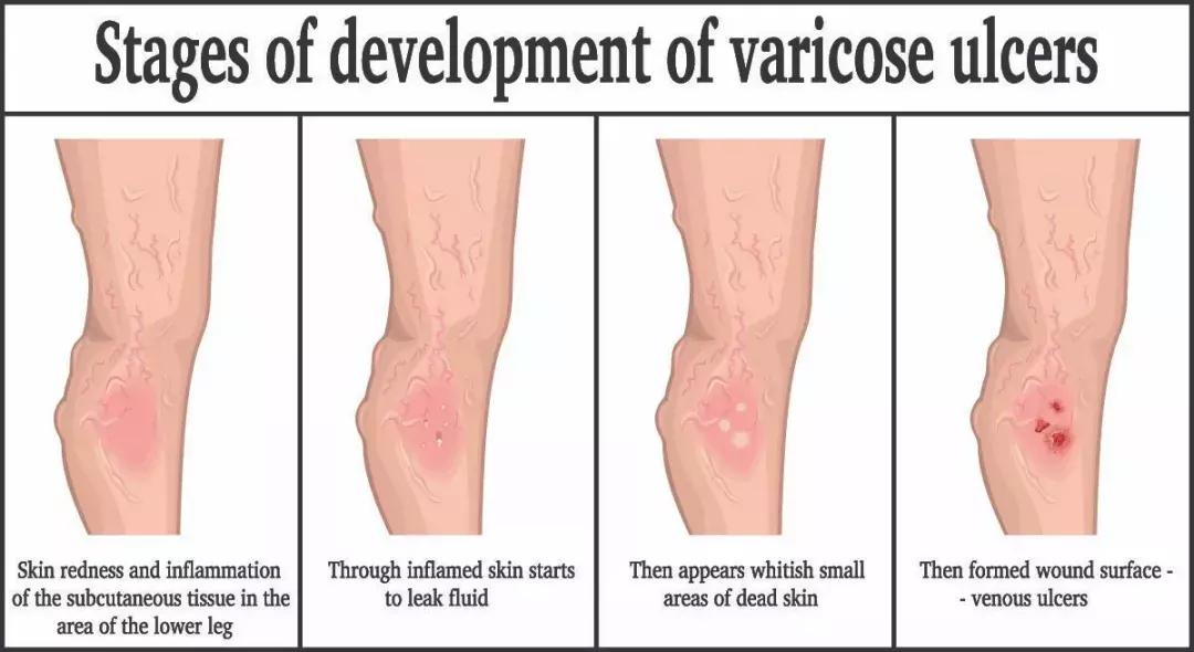 办公室白领，小腿一到下午就水肿，你有没有？